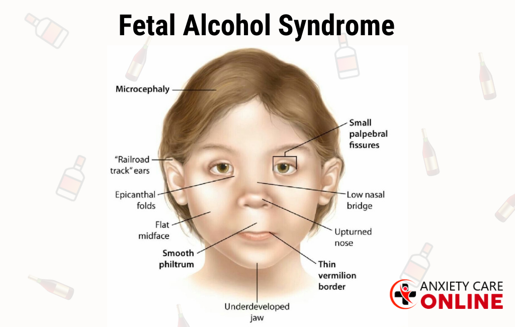 What is Fetal Alcohol Syndrome in Adults?